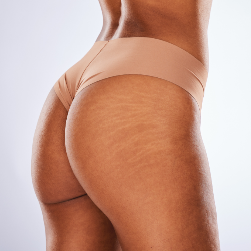 Booty Peeling Treatment Acne / Hyperpigmentation