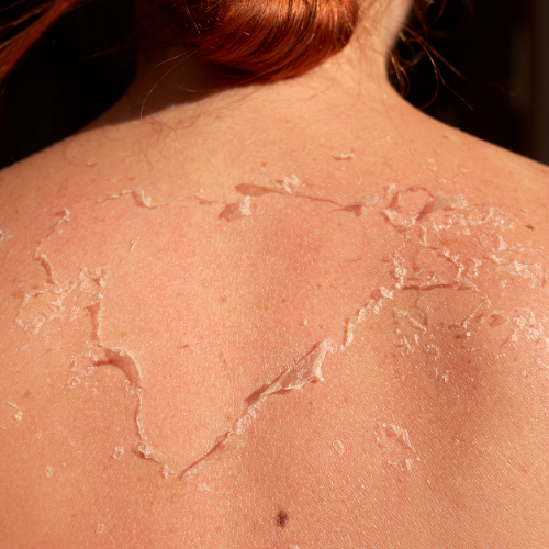 Back Peeling Treatment