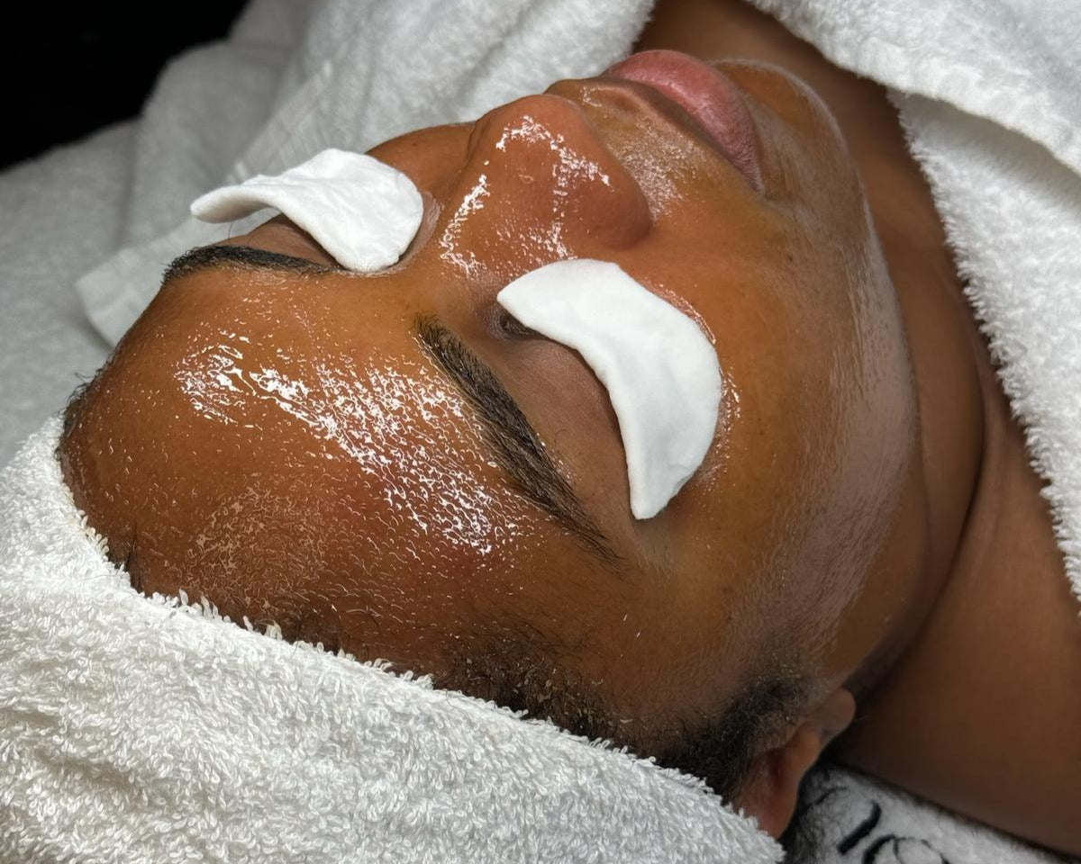 ASA Peel ® Treatment