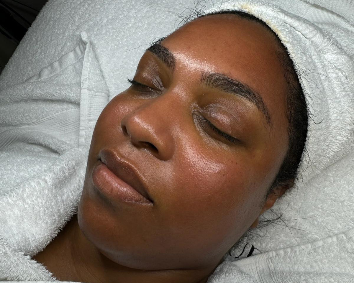 ASA Peel ® Treatment