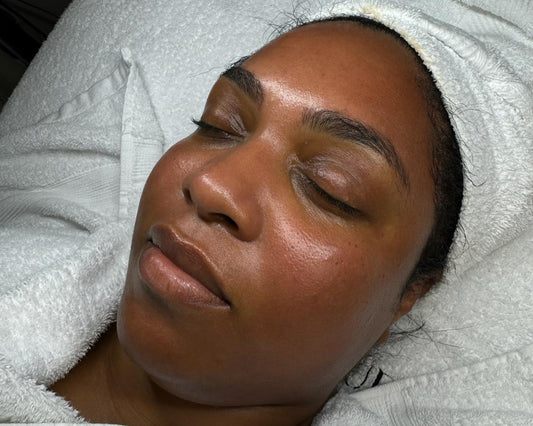 ASA Peel ® Treatment